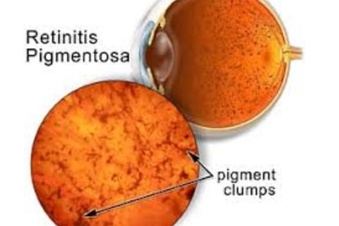 retinitis pigmentosa diagnosis
