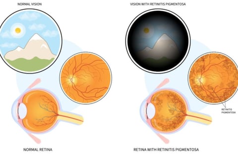 retinitis-pigmentosa