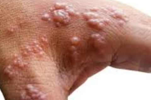 Shingles (Herpes Zoster) “Belt of Fire” Traditional vs. Strange Treatment