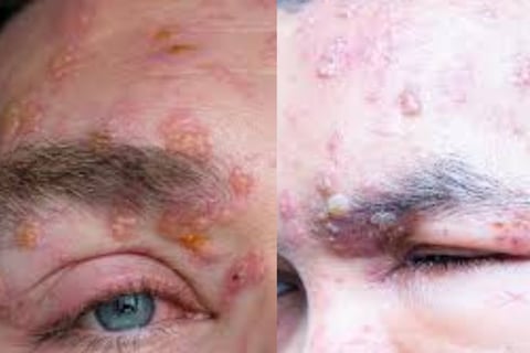 Shingles (Herpes Zoster) “Belt of Fire” Traditional vs. Strange Treatments