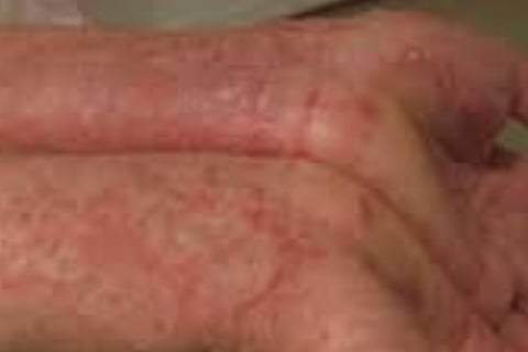 طفح جلدي أو ندوب حمراء، وقد تترافق مع حكة أو ألم