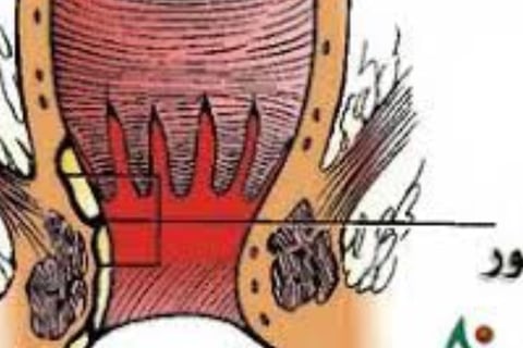 Using honey to treat fistulas is one of the effective methods that have been tried