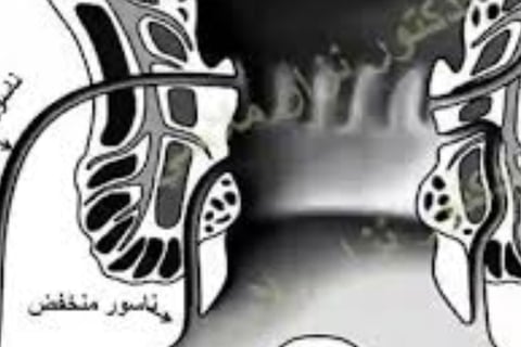 الشرخ و الناسور الشرجي