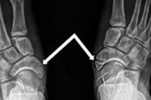 fracure foot
