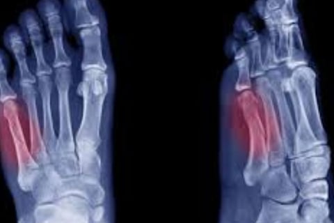 metatarsal fracure