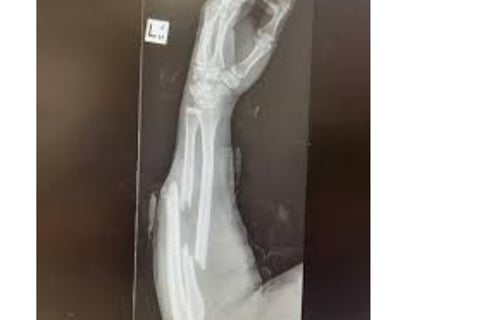 Why do some break when they fall down Without Getting Injured (1)