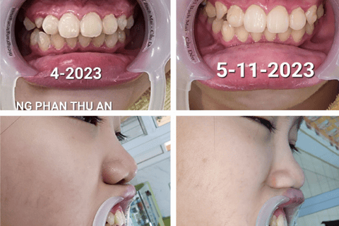 trước và sau niềng răng invisdental