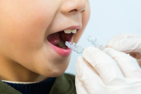 trẻ em niềng răng trong suốt