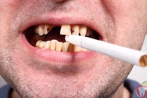 hút thuốc lá hại cho răng