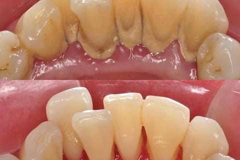 lấy cao răng định kỳ