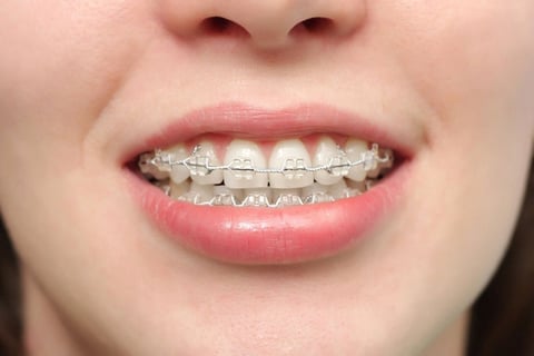 độ tuổi niềng răng