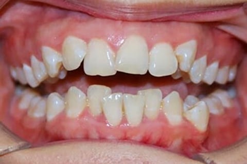 răng lệnh lạc