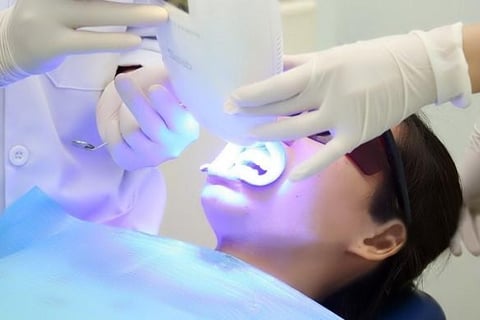 tẩy trắng răng an toàn không?