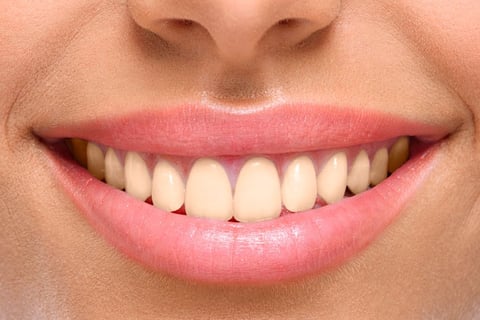sorriso antes do clareamento