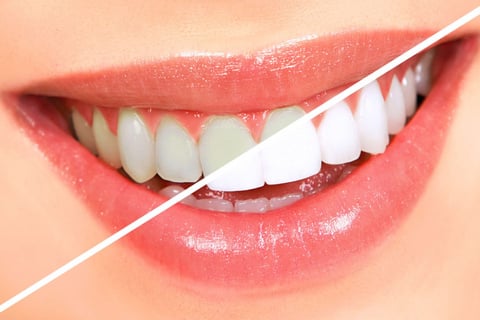 clareamento dental 1