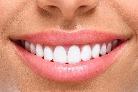 sorriso depois do clareamento