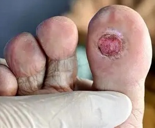 Ulcera bajo hallux derecho en pie diabético