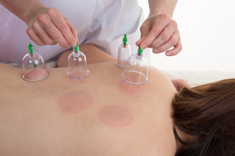 Cupping
