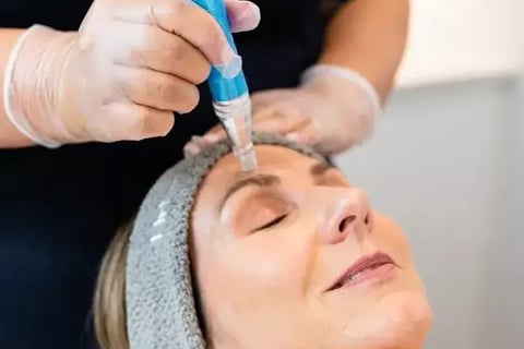 Skin Needling Benefits You Can’t Ignore!
