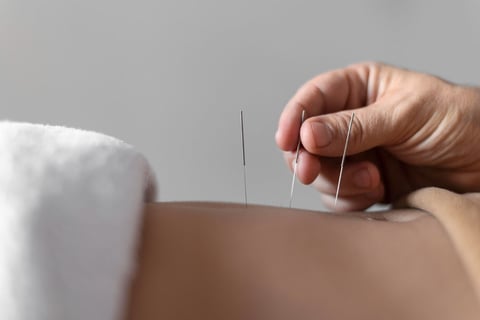 Close-up hand holding acupuncture needle.