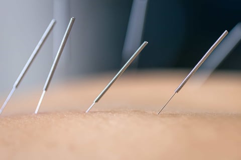 Acupuncture needles gently inserted into skin during treatment.
