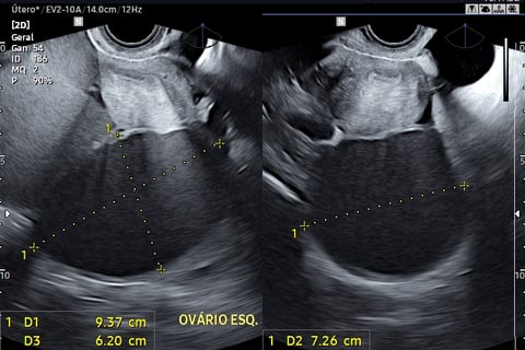 Endometriomas em paciente com dispareunia e dismenorreia