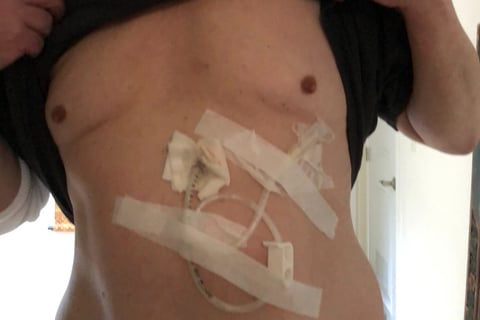 pic of feeding tube