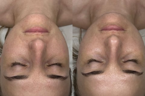 Oxygen Carboxy Therapy – Karboksyterapia
