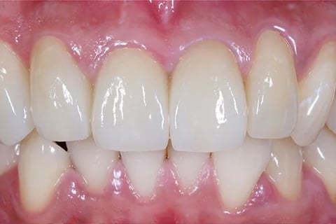 Sorriso in Zirconia