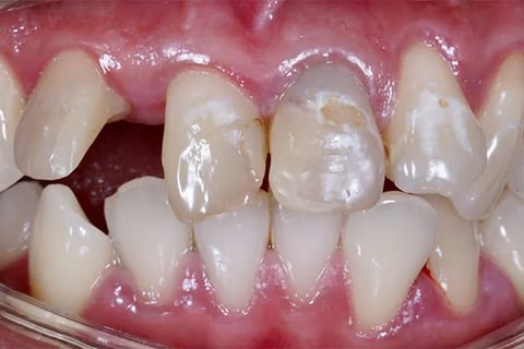 Prima: denti rovinati 