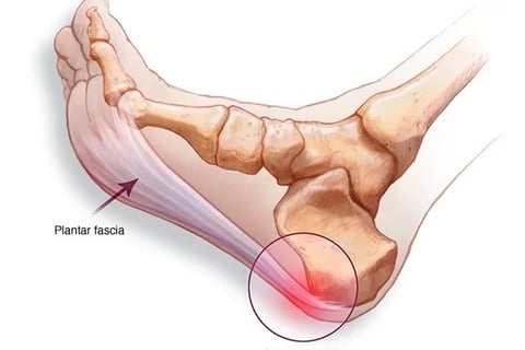 Solución Fascitis Plantar