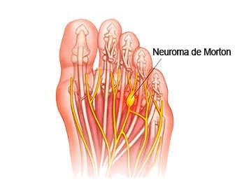 Solucion Neuroma de Morton