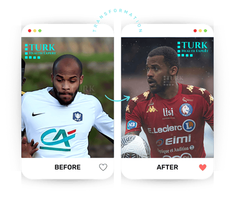 antes y despues del trasplante capilar