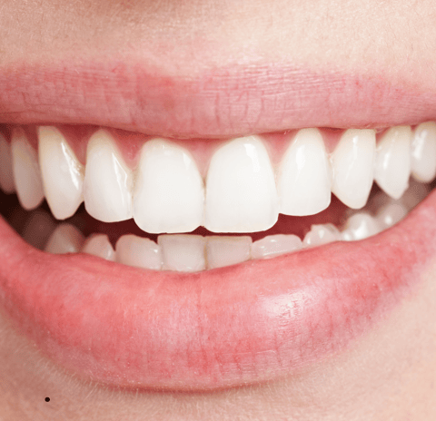 Dentist applying resin to a chipped tooth during a cosmetic bonding procedure.