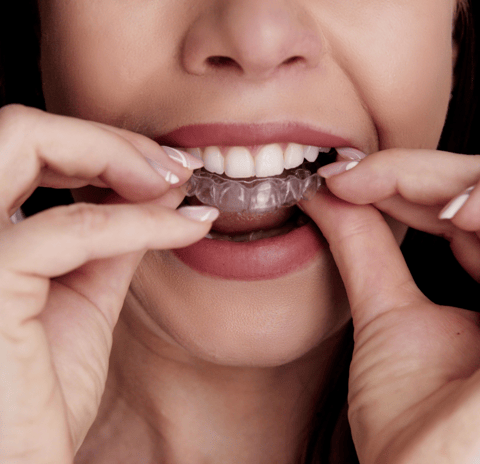 Close-up of clear aligners placed on a dental tray, showcasing their transparency and modern design