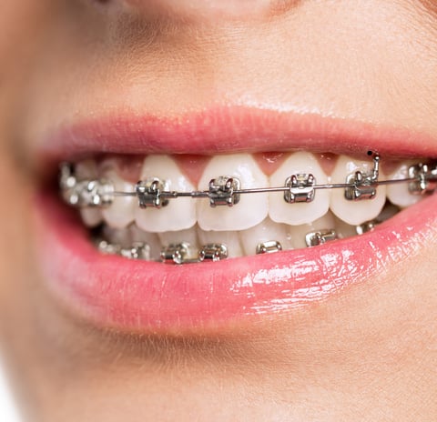 Teeth with traditional metal braces, showing durable and time-tested orthodontic care