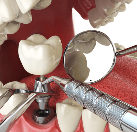 Close-up of a dental implant being placed into the jawbone during oral surgery