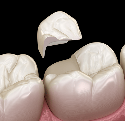 Dentist repairing a chipped tooth using dental bonding material in a clinical setting