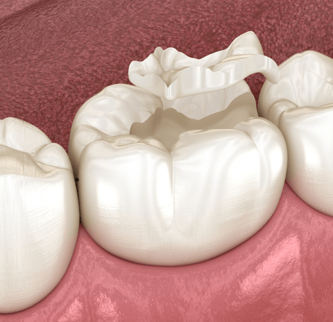 Dental professional fitting a replacement crown on a patient’s tooth after crown loss