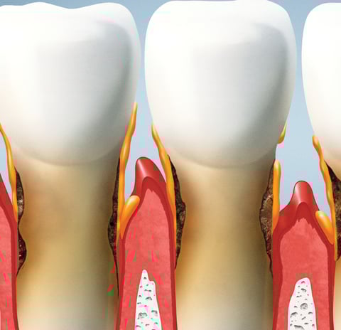 Close-up of a patient receiving professional gum disease treatment to restore oral health.