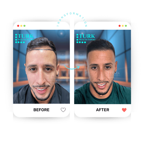 avant apres greffe de cheveux pilote