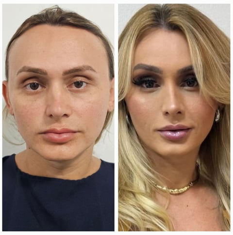 feminização facial frontoplastia