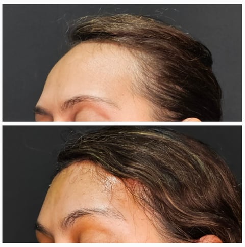feminização facial frontoplastia