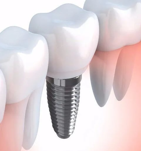 Dental Implant Clinic in Navi Mumbai | Ekdantam Dental Clinic