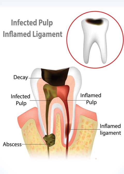 Root Canal Treatment in Navi Mumbai | Ekdantam Dental Clinic Navi Mumbai