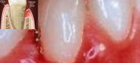 gums disease