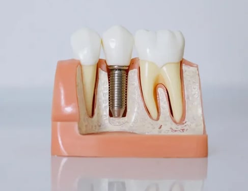 Mejores Implantes dentales en Sevilla