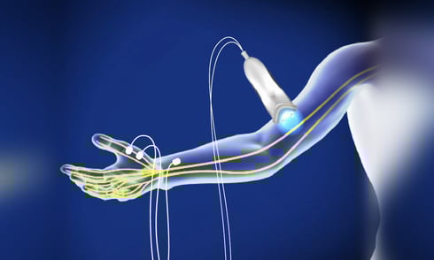 Nerve Conduction Study-Dr. T. Aravindh MBBS, MS( ORTHO)