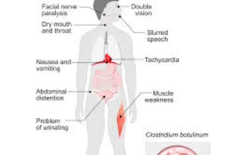 Botulism Separating Fact from Fiction (2)