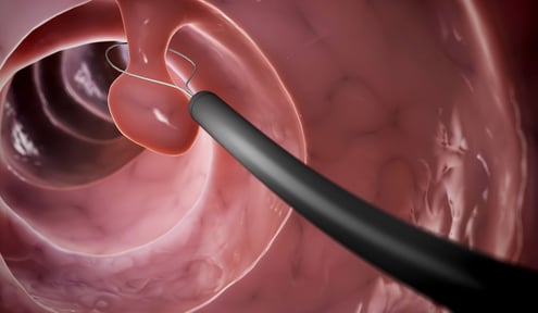 colon Polyps GASTRO FOUNDATION